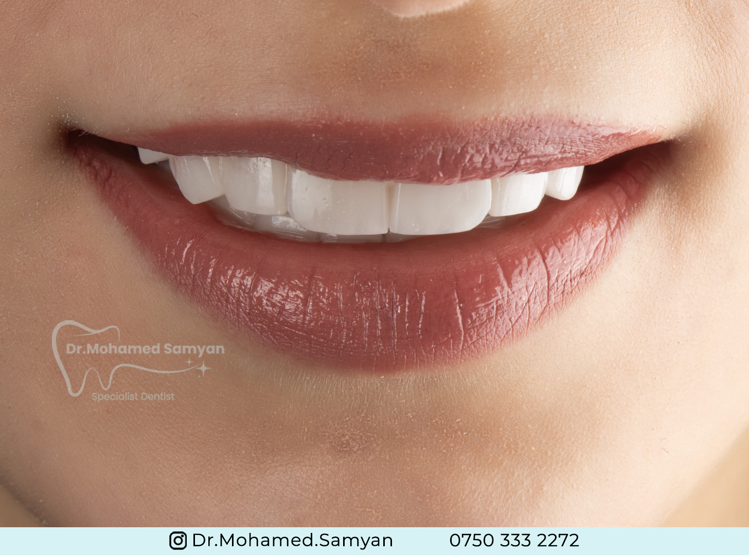 Veneers