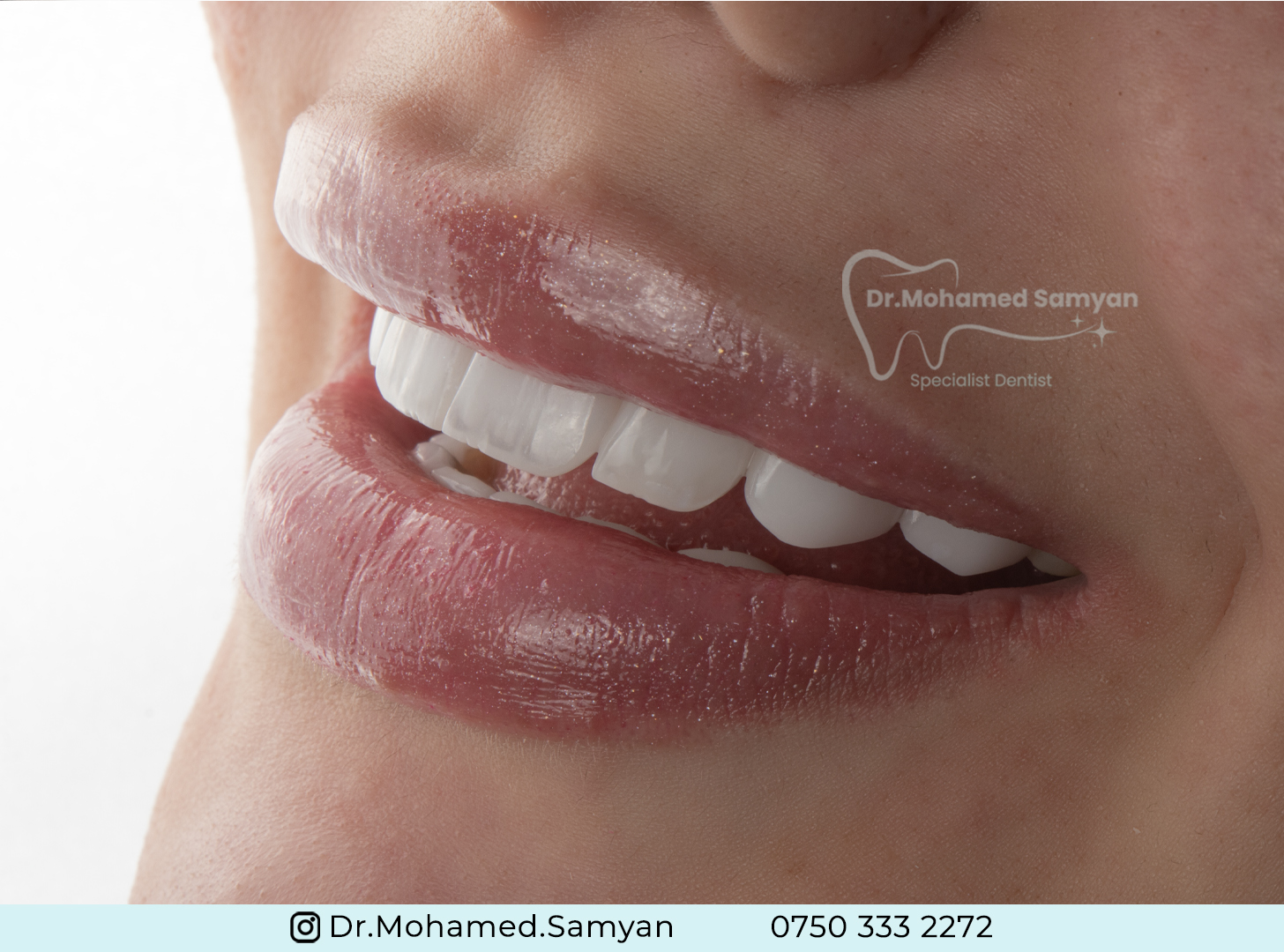 Veneers