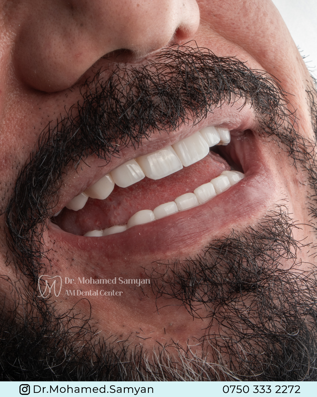 Hollywood Smile