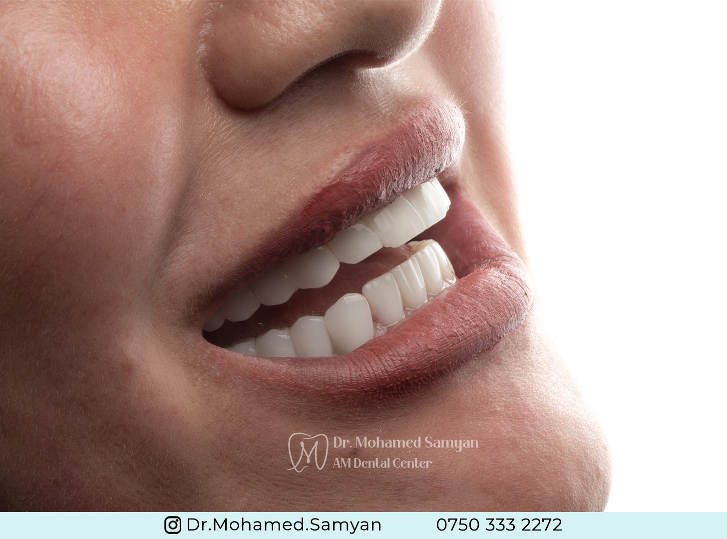 Hollywood Smile
