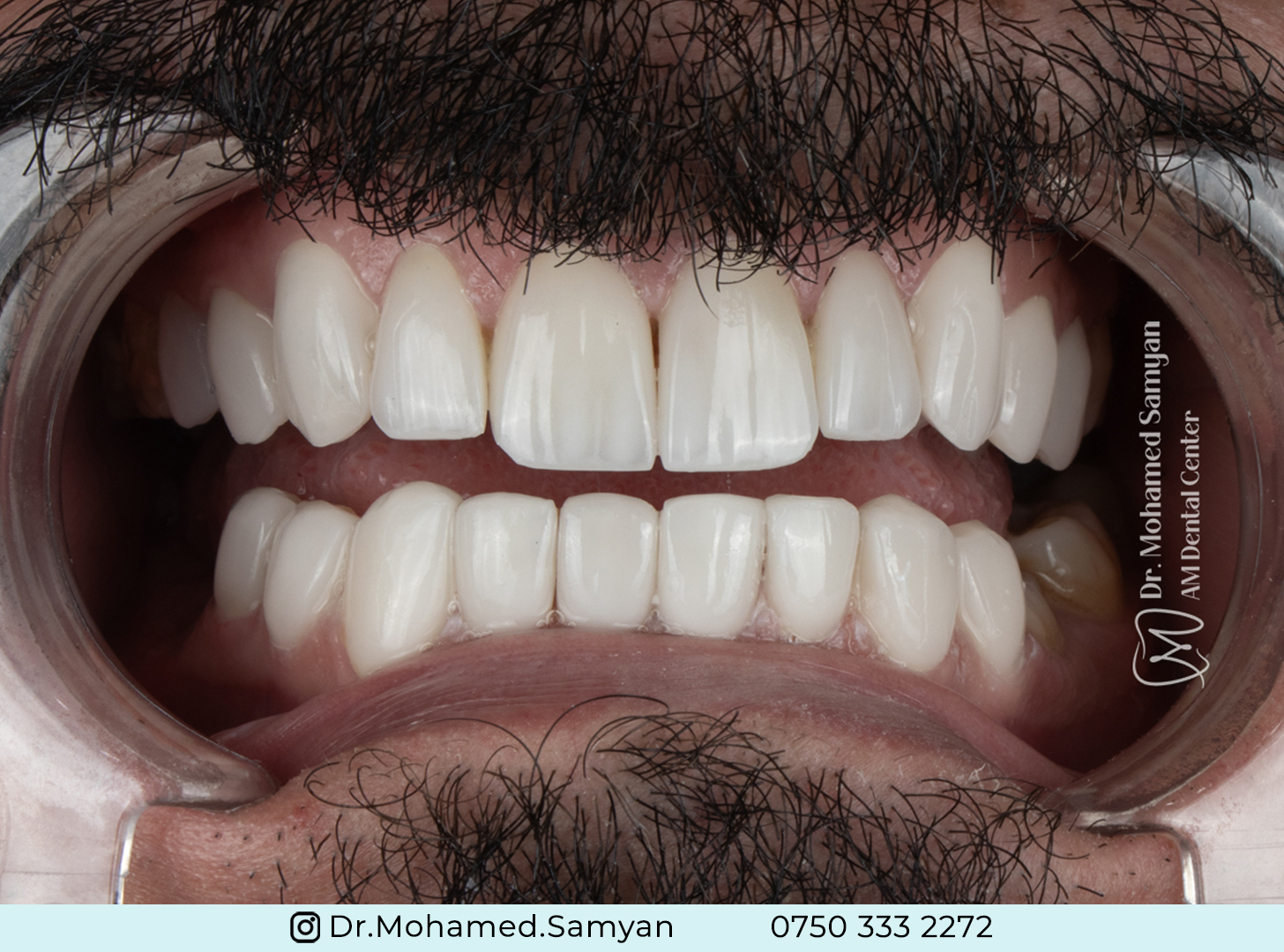 Hollywood Smile