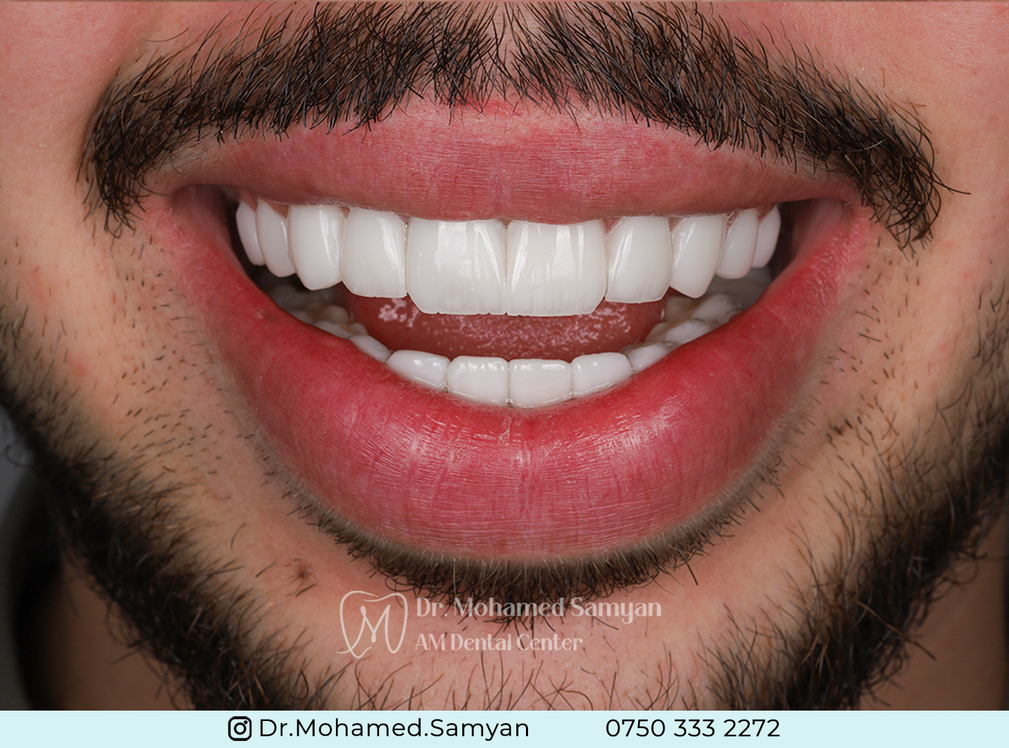 Hollywood Smile