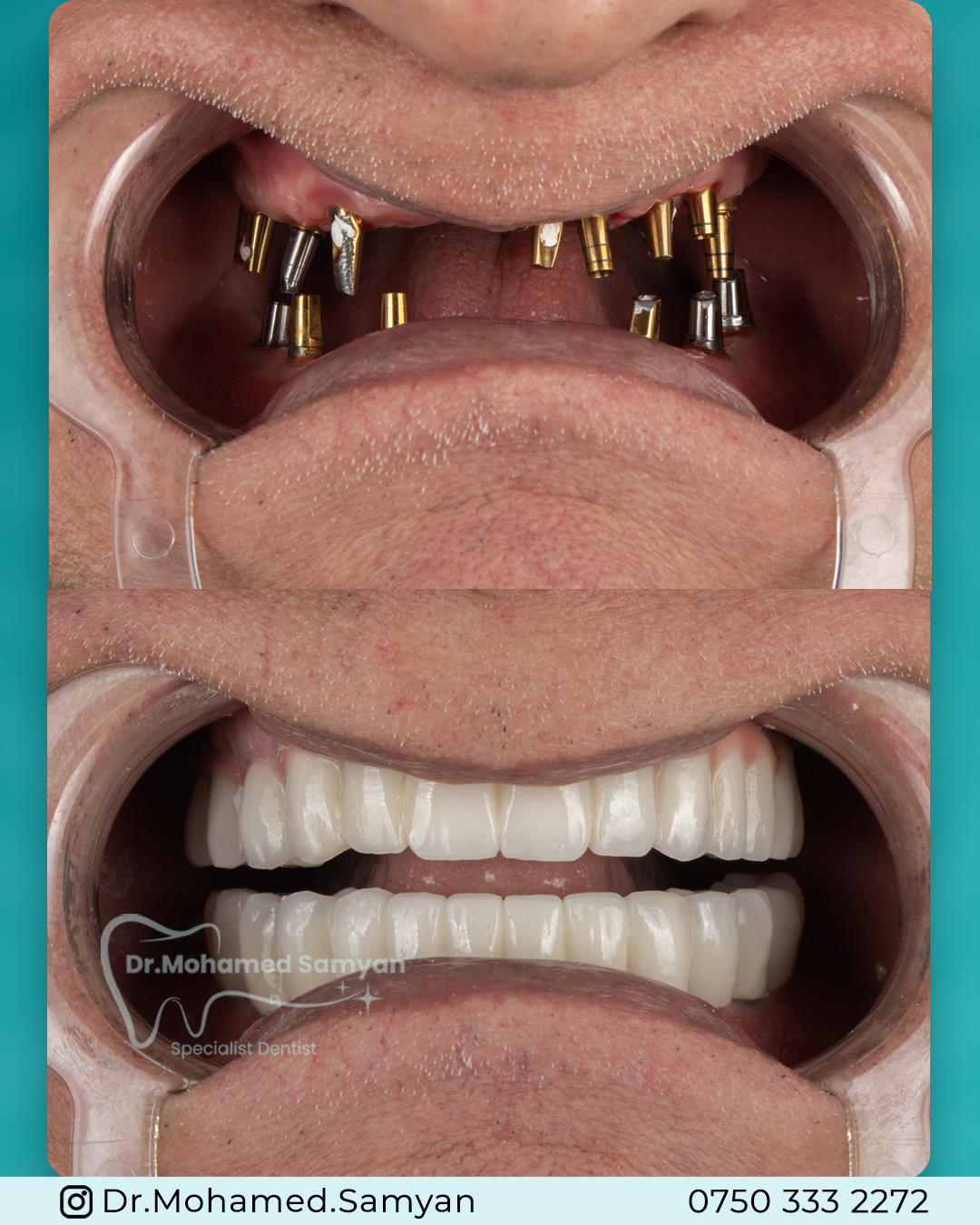 Dental Implant