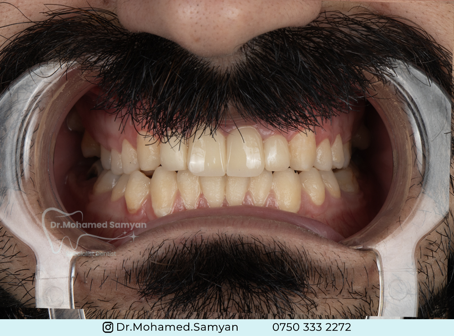 كراسكرنا ددانان